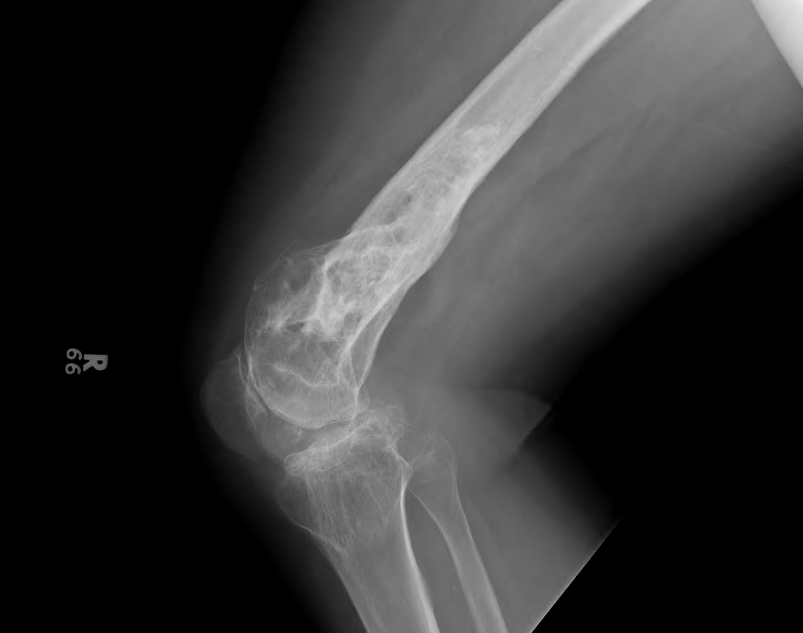 Previous Unicondylar Fracture 1